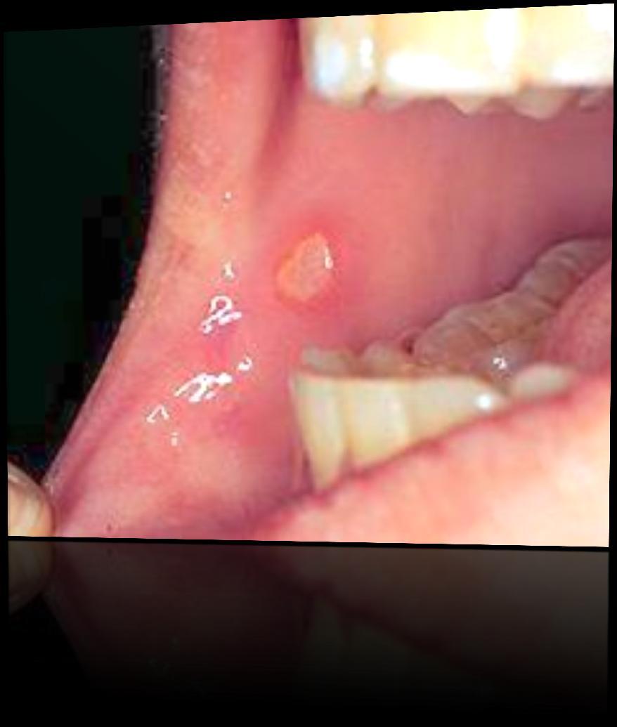 Oral aphthous ulcer