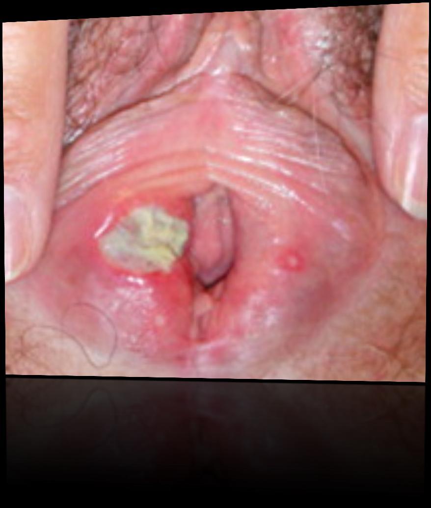 Pearl Vulvar aphthous ulcer Credit: Dr. Andrew T. Goldstein Huppert JS et al.