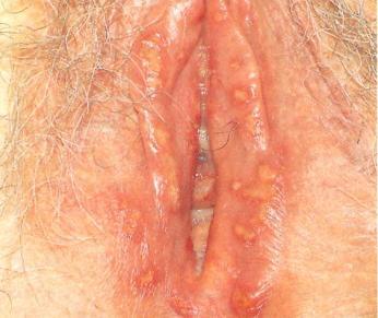 Herpes, primary Genital