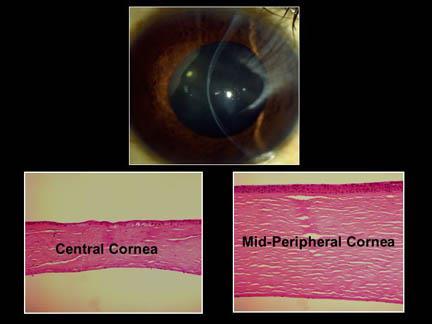into deep corneal stroma to flatten the central cornea Indicated for mild to moderate