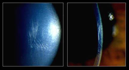 need for keratoplasty although significant refractive error may remain Refractive stability has