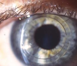 tissue to reduce the SE These changes should improve the UCVA and increase contact lens or