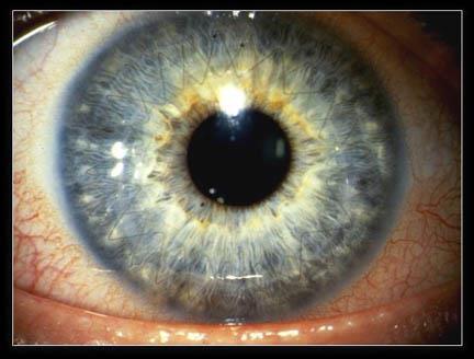 by an area of uninvolved, normal cornea between the thinned zone and the limbus.