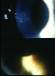 improves as day wears on chalky patches/dots in lower 2/3rd of cornea RCE: Treatment