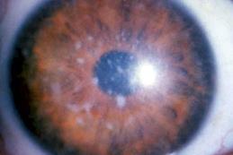 Conventional Uses Non-Healing Epithelial Defects Neurotrophic Ulcerations Corneal Erosions Acute Chemical/Thermal Burns Post-Infectious Keratitis