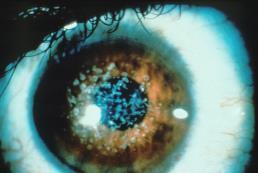 With age: increasing number, density, size and depth of opacities intervening stroma and peripheral cornea remain clear Granular Dystrophy: (Groenouw Type I) RCE are common
