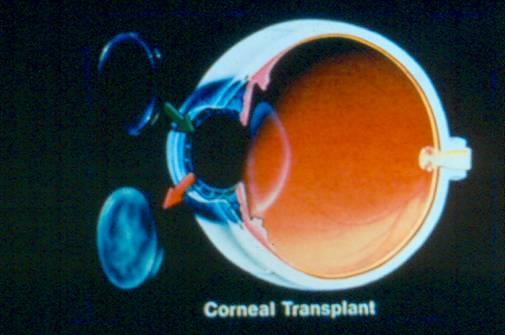 Central Crystalline Dystrophy of Schnyder Vision is typically mildly affected though there maybe associated systemic