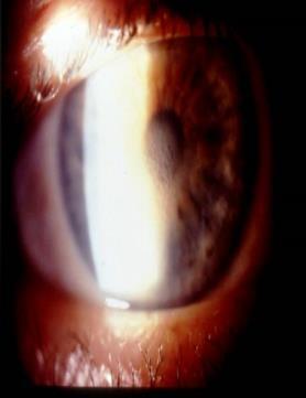 Fuch s Dystrophy: Guttata Corneal guttata excessive accumulation of abnormal endo secretions is associated with the disease
