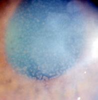 may help reduce epithelial corneal edema in the morning bandage CL can be used in the presence of bullous keratopathy Fuch s Dystrophy: Treatment When visual function deteriorates to the point