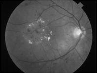Nonproliferative diabetic retinopathy