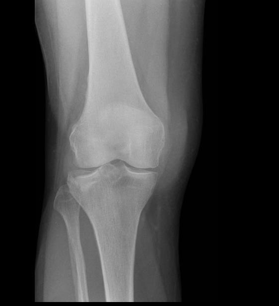 TIBIAL PLATEAU FRACTURE