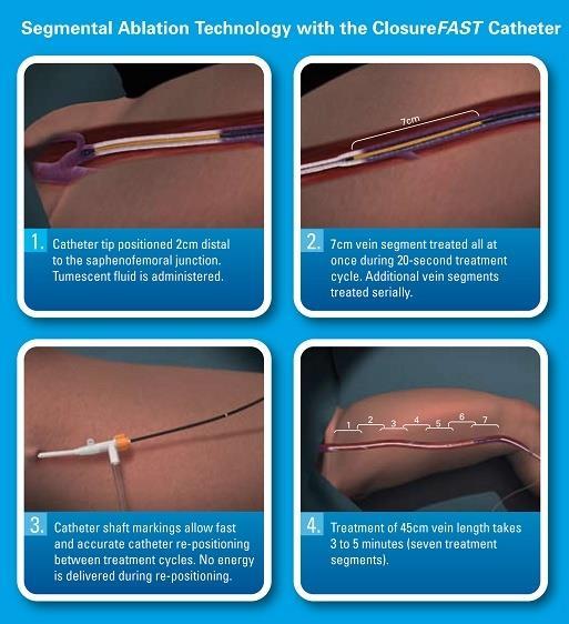 Endovenous ablation of GSV - Radiofrequency ablation (RFA) - Foam sclerotherapy (ultrasound guided foam sclerotherapy-ugfs) - Laser