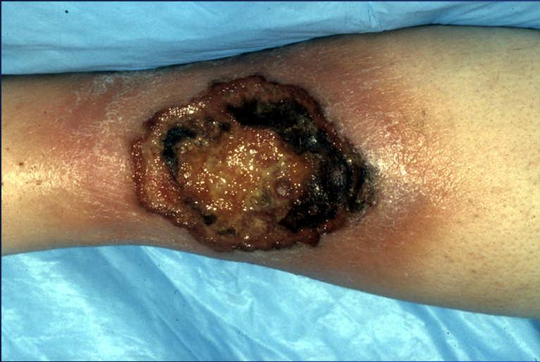 Extensive Leg Ulcer Extensive