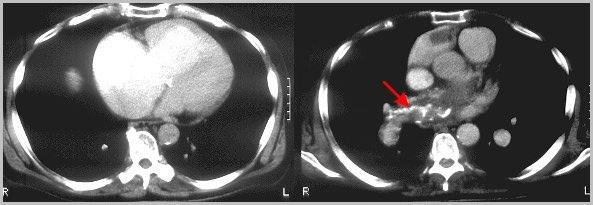 CT Scan Noninvasive and Rapid Risk to patients with borderline renal function Identifies proximal
