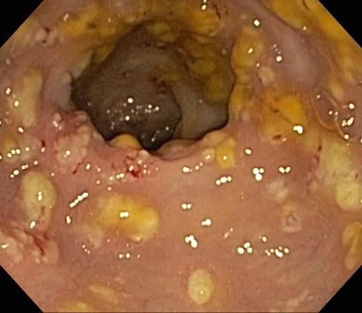 Role of Antibiotics in IBD Crohn s disease: colonic involvement, fistula, perianal disease, abscess