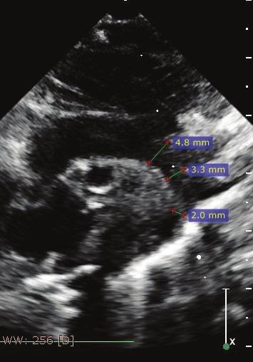 1 3 It is a common malformation, occurring in about 5 7% of all patients with congenital heart defects, with an incidence of 4 out of 10,000 live births.