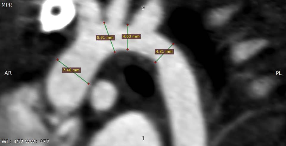The assessed parameters were: diameters of the aorta at the level of the aortic annulus, coronary sinuses, sinotubular junction, ascending aorta, proximal transverse arch (T1 measurements were
