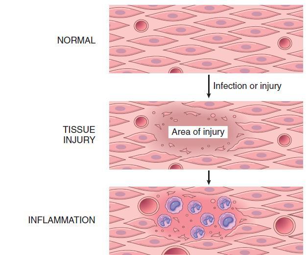 Steps in repair by scar formation Injury to a tissue that has limited