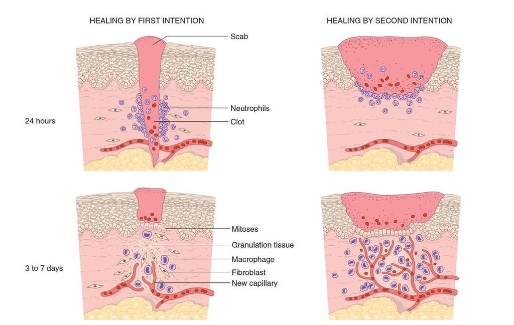 Steps in wound healing by first intention (left) and second intention (right).