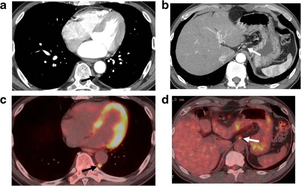 Ninomiya et al. Surgical Case Reports (2015) 1:25 Page 3 of 6 Figure 2 The computed tomography findings. Findings of the metastatic mediastinal (a, c) and abdominal (b, d) lymph nodes.