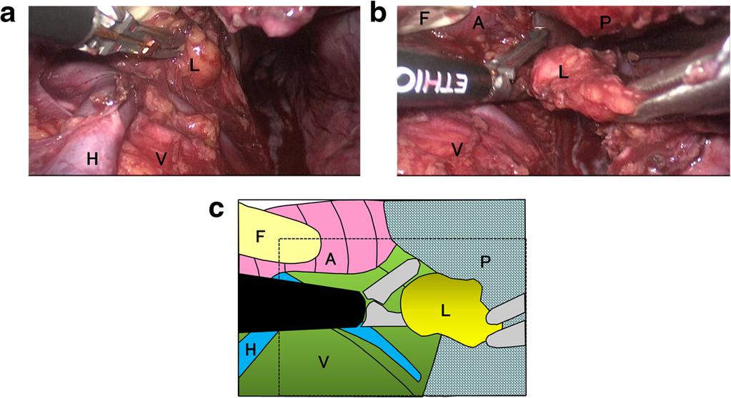 Ninomiya et al. Surgical Case Reports (2015) 1:25 Page 4 of 6 Figure 4 Operative findings and schematic illustration of transhiatal dissection of the retroaortic lymph node.