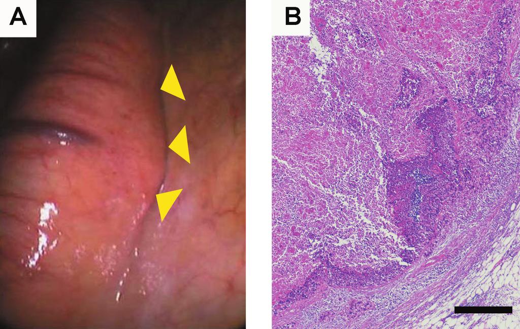 October 2012 Solitary Paraaortic LN-metastasis A 419 B Fig. 2 Intraoperative and pathologic ﬁndings for the paraaortic lymph-node metastasis.