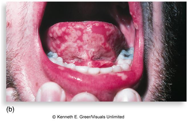 Type 1 Herpes Simplex in Children and Adults Herpes labialis fever blisters, cold sores; most common recurrent HSV-1 infection; vesicles occur on mucocutaneous junction of lips or adjacent skin;