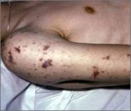Outbreak of Invasive Meningococcal Disease NYC