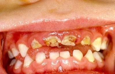 Early Childhood Cavities Cavities in