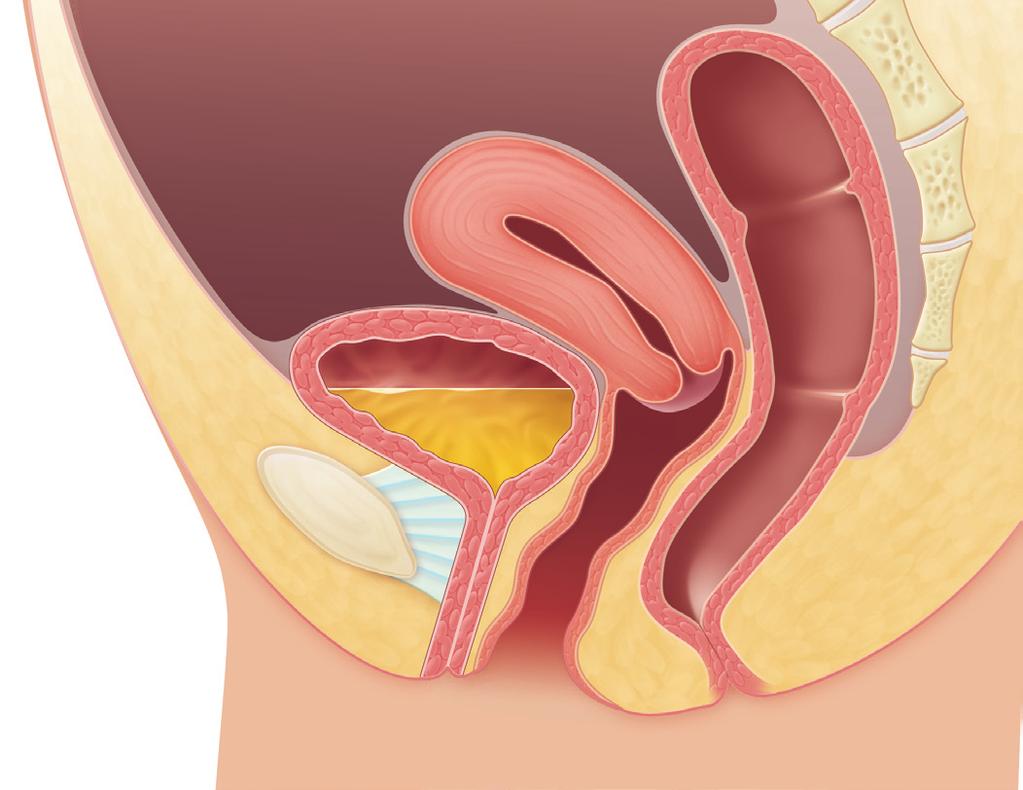 Stress Urinary Incontinence Uterus Normal Pelvic Anatomy Bladder Pelvic bone Cervix Normal urethral