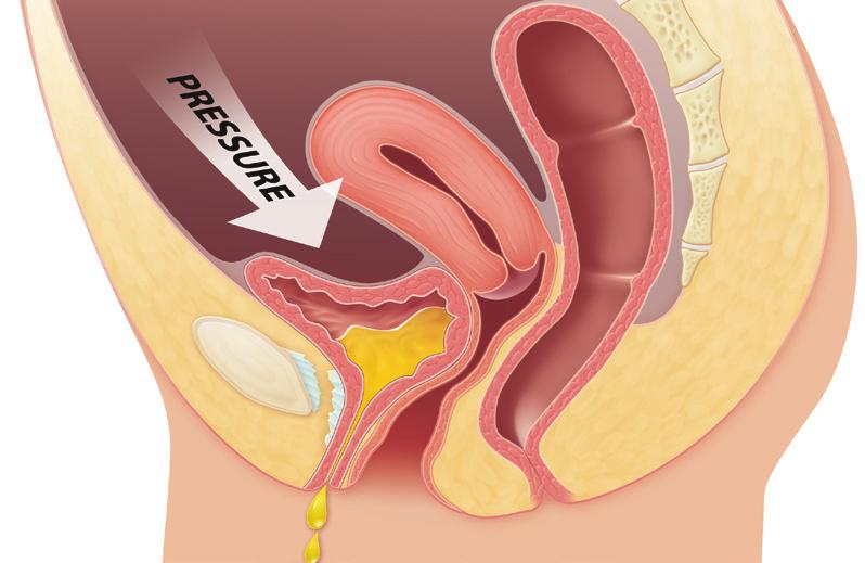 Incontinence (SUI) Loss of urethral support Stress Urinary Incontinence (SUI) Loss of urethral