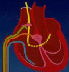 Diagnostic Electrophysiology Diagnostic catheters are inserted percutaneously and then threaded through the vena cava into the heart.