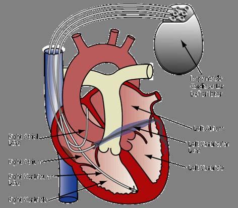 Bi-Ventricular Devices What differentiates biventricular devices from conventional