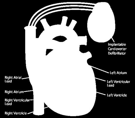 All cardiac rhythm devices have leads on the heart s right side, either the right