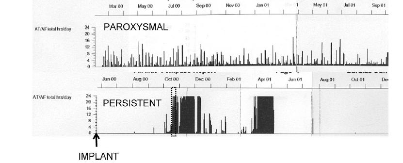 Progression of paroxysmal atrial fibrillation to persistent atrial fibrillation in patients with bradyarrhythmias Sanjeev Saksena, MD,