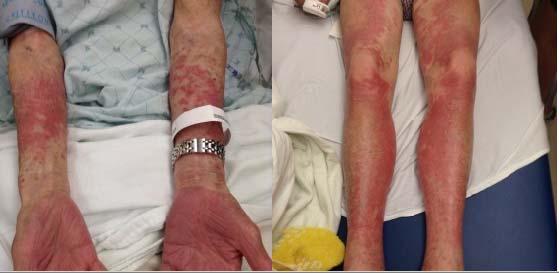 Management of Side Effects: Derm Fixed drug eruption Rash, itching (1-5%, RIF) Pemphigoid reaction DRESS / DIHS Anaphylaxis, urticaria Mild: anti histamine, topical steroids, f/u visit Mild moderate: