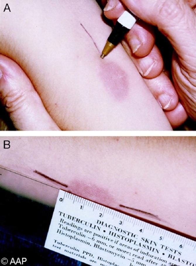 Tuberculin skin test Indicates infection & not disease TST is positive if: > 5mm in high risk children (HIV+ or malnourished) > 10mm in all other children Main limitation low sensitivity