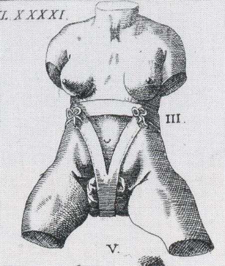 Schultes truss (1655). Figure 4.3: Wolveridge s bagg device compared to Schultes truss.