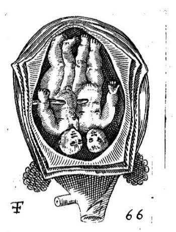 Illustrations feet option. An example of twins with both heads presenting is included in Figure 4.13 to demonstrate the similarities between the authors.