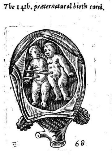 Illustrations Wolveridge, feet presenting Sloane 2463 twins Figure 4.32: A set of twins in Wolveridge compared to an image in Sloane 2463.