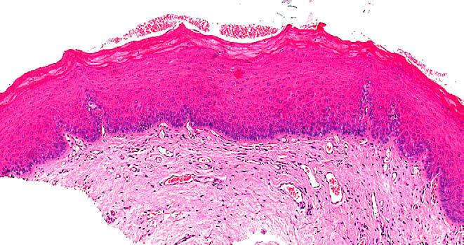 may look like fibro-epithelial polyps both clinically and histologically. None of the viral papillomas carries any pre malignant connotation.