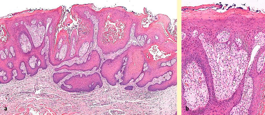 papillonodular morphology. Figure 1 Biopsy from the cheek mucosa showing a chevron papillary surface pattern of a smoking-related hyperkeratosis.