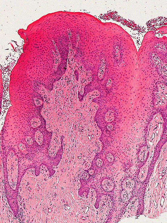 Figure 3 Papillary hyperplasia of the dorsum of the tongue associated with median rhomboid glossitis. A PAS stain confirmed the presence of candidal infection.
