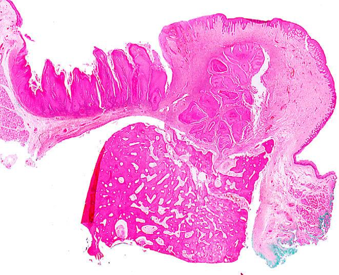 The rete processes are cytologically bland, broad, elongated and widened, with a so-called elephant s foot appearance. Plugs of keratin may extend to the full depth of the rete ridges.
