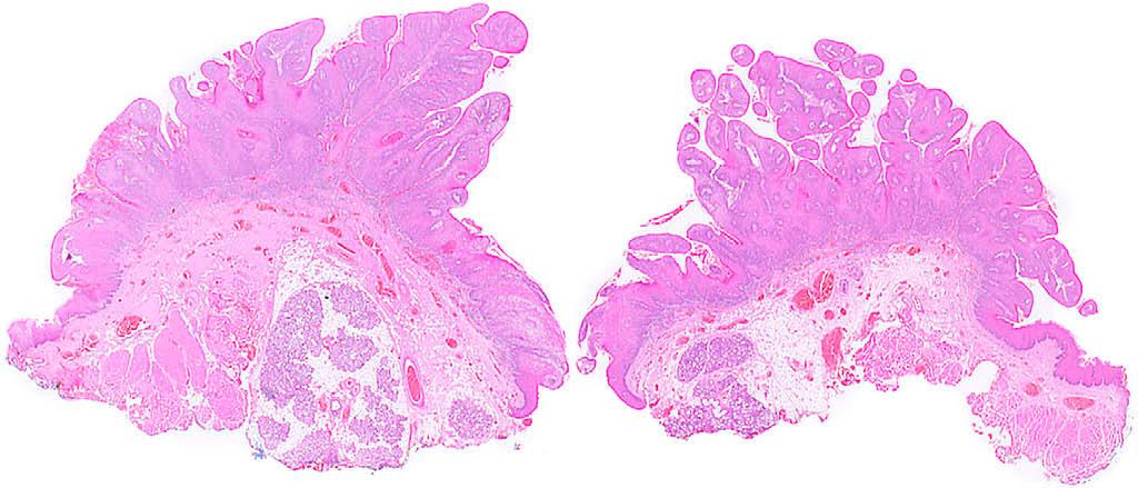 Sharp verrucous hyperplasia with pointed, prominently hyperkeratinized surface projections. a There is an exophytic growth pattern with most rete ridges having a pointed or square deep aspect.