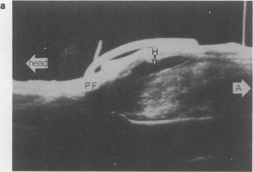 24 J.M. BELL et al. a ed Figure la Case 1. Ultrasound of the calf, midline longitudinal scan with the patient prone.