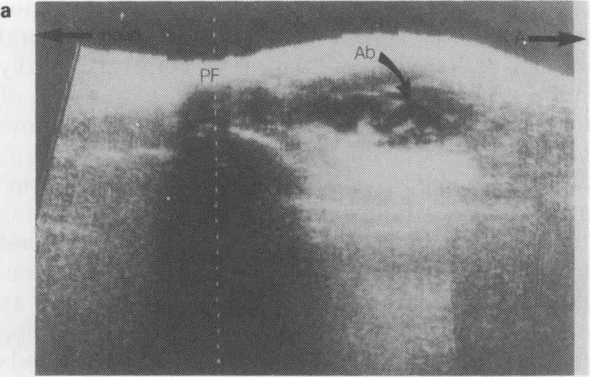26 J.M. BELL el al. b Figure 3a Case 4. Longitudinal ultrasound scan of the calf with the patient prone.