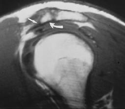 Impingement Syndrome Decrease in subacromial space due to -Ant.