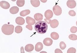 Case 2 A peripheral blood smear (the slide