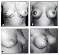 Figure 4. A, "Ideal" breast contour. B, Breast contuor after simultaneous periareolar mastopexy and breast augmentation.